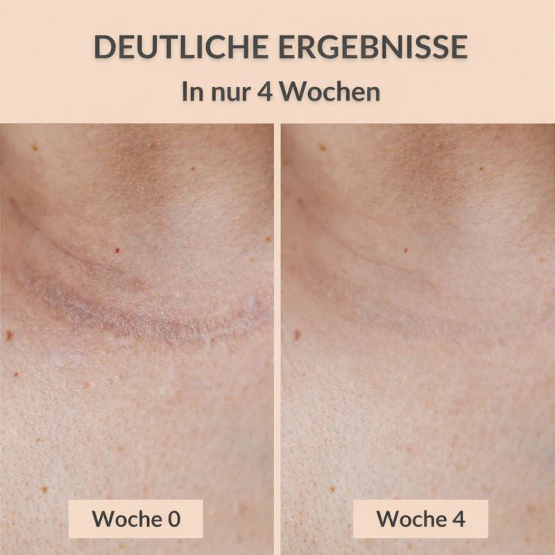 Melano® Silikon-Narbenpflaster