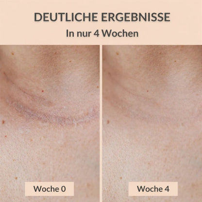 Melano® Silikon-Narbenpflaster